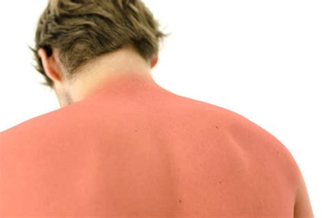 Suffering From Sunburn? Here’s How You Can Take Care of it Through Home Remedies – Pilates ...