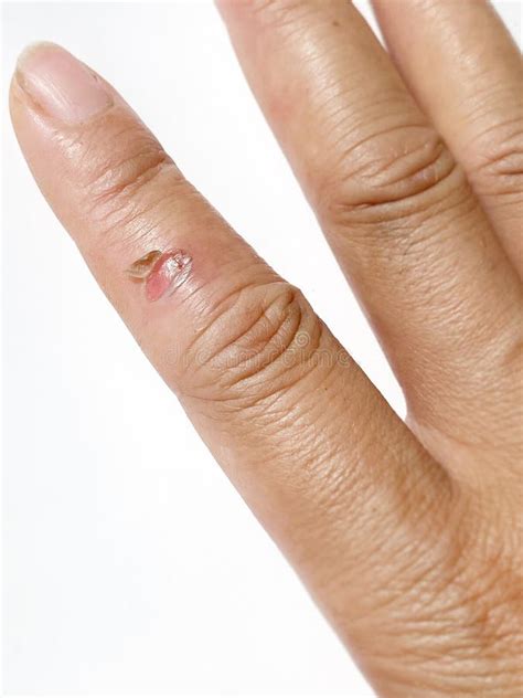 Popped Blister Wound Caused by Burning on Finger. Hot Rubber Liquid Splash Over the Skin Caused ...