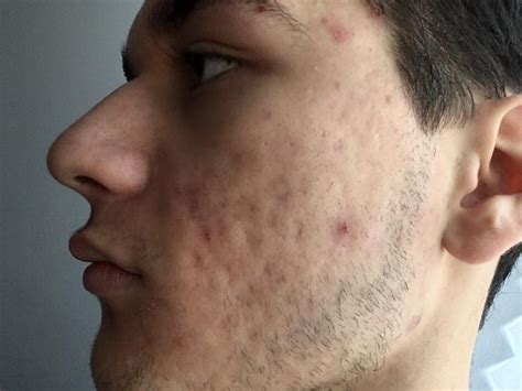 Acne scars, hyperpigmentation and other – Scar treatments – Acne.org Forum