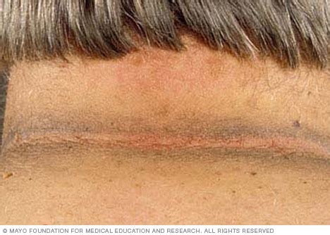 Acanthosis nigricans - Symptoms & causes - Mayo Clinic