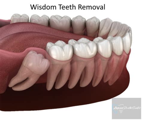 Step by Step Wisdom Tooth Removal: A Pain-Free Journey - favourite dentistry