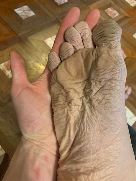 Man told he has 'trench foot' after wearing a pair of wet boots for 10 ...