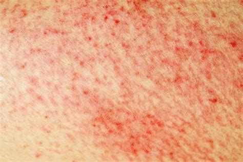 What is shingles: symptoms, description with photo, causes, treatment and prevention | Health 2024