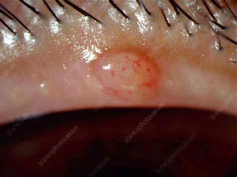 Conjunctival Cyst - Stock Image - C027/1496 - Science Photo Library