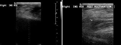 (a, b): Ultrasound scan of the right groin demonstrating a right... | Download Scientific Diagram