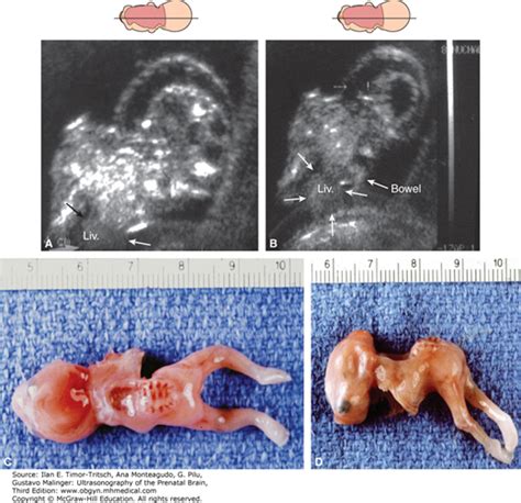 ANOMALIES OF DORSAL INDUCTION | Radiology Key