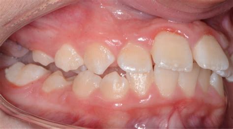 Clear Aligners the before and after | Master Clear Aligner