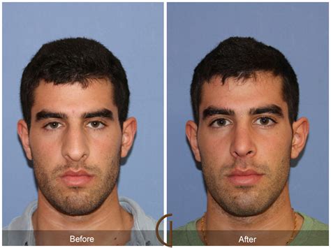 Septoplasty And Turbinate Reduction