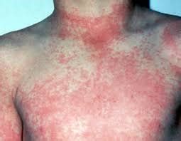 Dengue Hemorrhagic Fever | Sign and Causes | Diagnosis