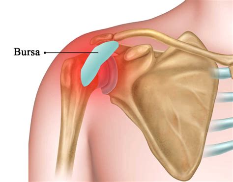 Osteopathic Treatment Of Shoulder Bursitis | Better Health Osteopathy