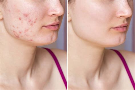 ACNE - Reasons to See a SCI Dermatologist for Acne Treatment | Skin And Cancer Institute