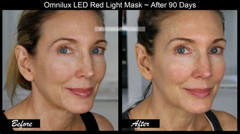 OmniLux LED Mask ~ 3 Month Results! Before & After Face, Neck, & Hand ...