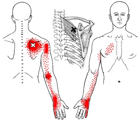 What is Trigger Point Therapy? | PalmLeaf Massage Clinic — Buffalo Grove, Illinois