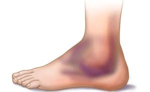 Swelling and Bruising of the Ankle, Heal & Treat - Treat MD