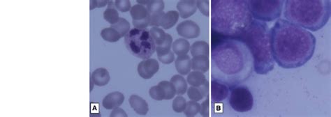 a Peripheral smear showing macro-ovalocytes, hypersegmented neutrophils... | Download Scientific ...