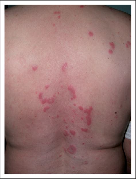 lupus cutaneous | Semantic Scholar