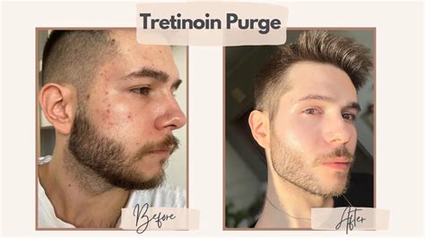 The Tretinoin Purge - How Long Does It Last?