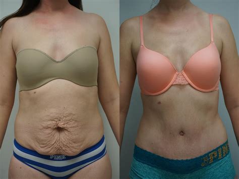 Tummy Tuck Before And After