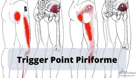 Trigger Point Piriforme | Scopri come agire! - Mdm Fisioterapia