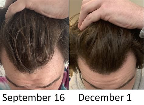 Sharing one month of progress in hair regrowth from supplementation : tressless