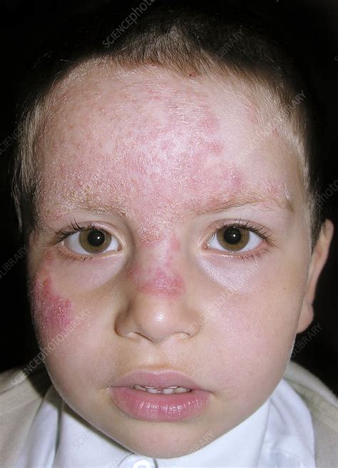 Tinea fungal infection on the face - Stock Image - C014/2548 - Science Photo Library