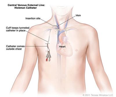 Dialysis Port Or Catheter