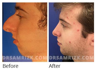 Rhinoplasty Before And After | Nose Job Gallery
