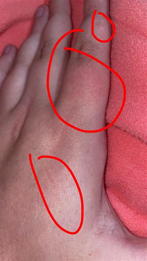 Is this scabies or am I paranoid? : r/scabies