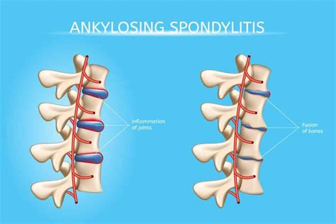 Information about Ankylosing Spondylitis | Blackberry Clinic Blog