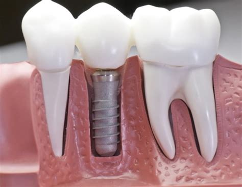 Risks of Dental Implants | American Cosmetic Dentistry