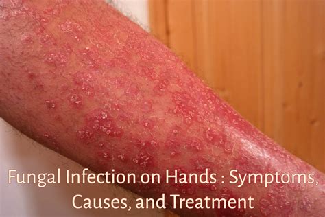 Fungal Skin Rash On Hands | Images and Photos finder