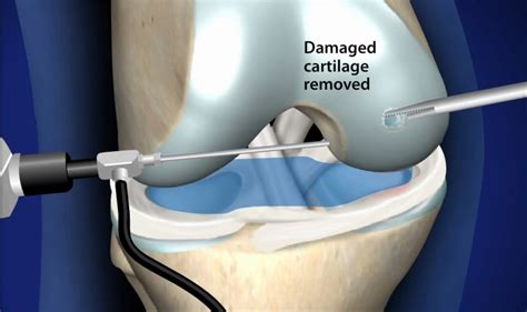 Chondroplasty - Arthroscopic Surgery