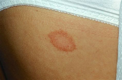 Pityriasis Rosea Causes Rash Herald Patch Stages | Sexiz Pix