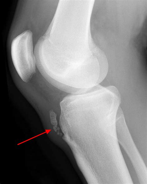 Osgood Schlatter Disease - Causes, Symptoms, Prognosis & Treatment