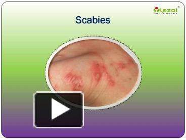 PPT – Scabies: Causes, Symptoms, Daignosis, Prevention and Treatment PowerPoint presentation ...