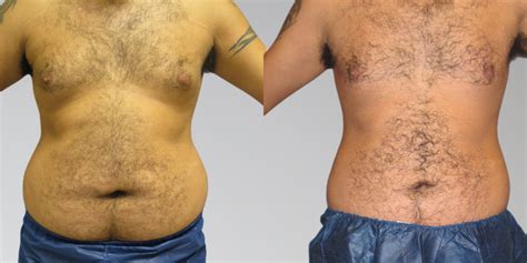 Men Before and After Stomach Liposuction | Sono Bello