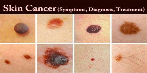 Skin Cancer (Symptoms, Diagnosis, Treatment) - Assignment Point