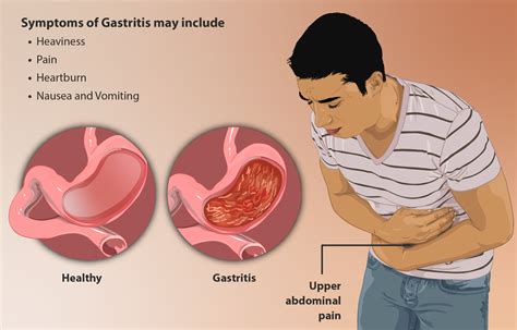 Gastritis