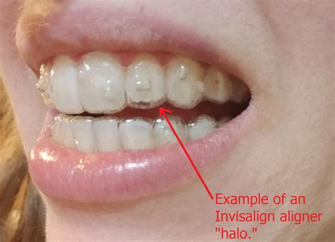 How Do I Know If My Invisalign Clear Aligners are Tracking?