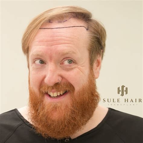 Why Hair Transplantation in Turkey is the Best in the World?