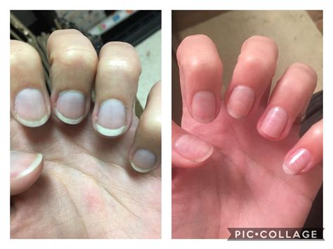 After 6 months my nail beds have regrown! (Details in comments) : r ...