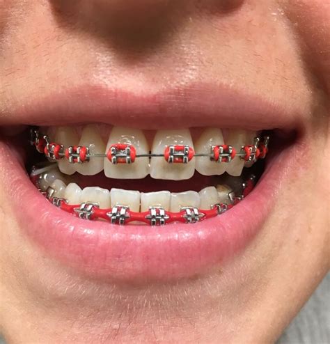 Pin by Gianellavv on braces | Braces teeth colors, Teeth braces, Cute braces colors