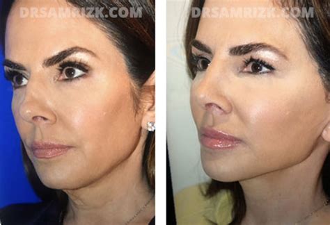 Jennifer Fessler Facelift & Nose Job | Dr. Rizk’s Patient