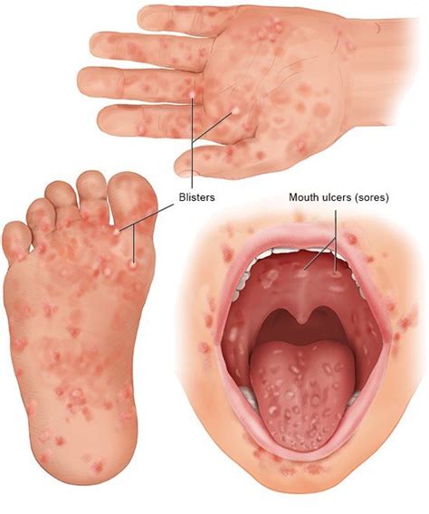 Hand, foot and mouth disease | informedhealth.org