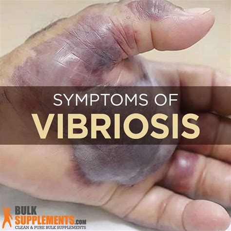 What is Vibriosis: Causes, Symptoms & Treatment