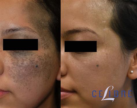 Birthmark Removal Before and After Pictures