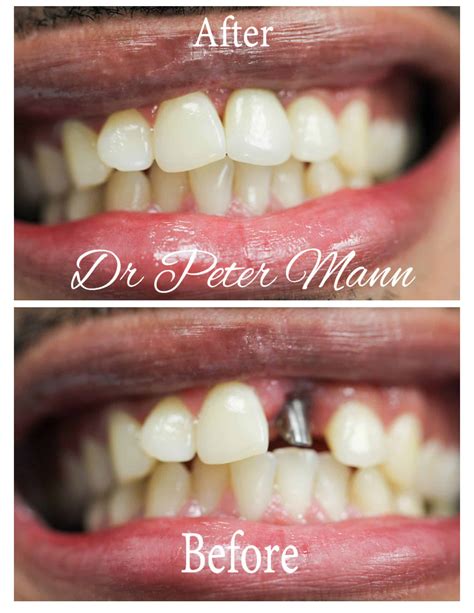 Tooth Implant Before And After