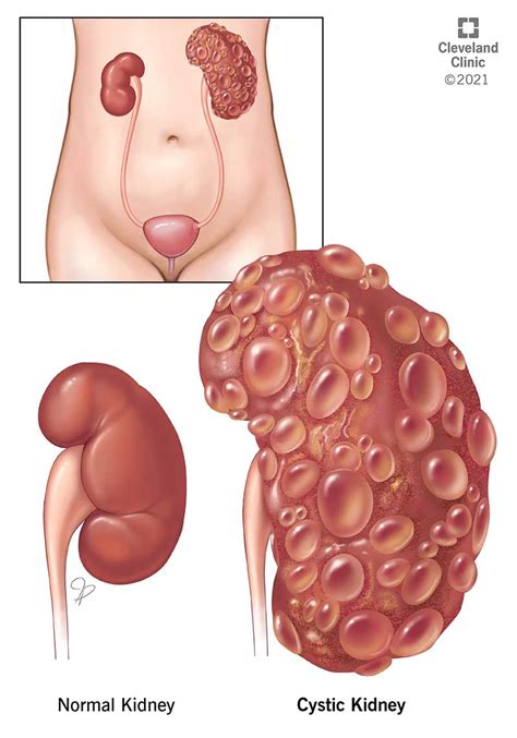 Cystic Kidney Disease: Types, Causes, Symptoms & Treatment