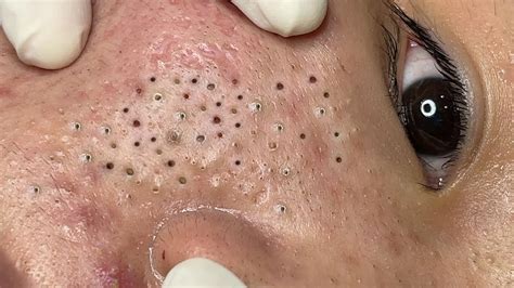 Treatment Blackheads and Acne Hidden Under The Eyes - YouTube