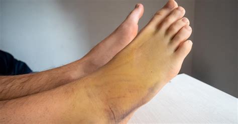 Foot Bruises: Types, Medical Causes, Complications